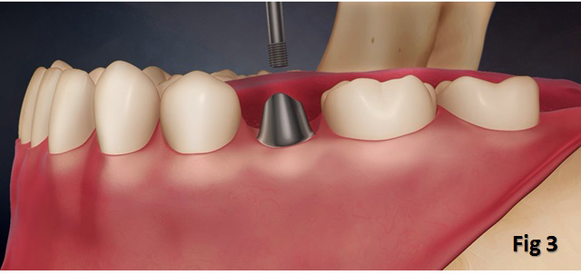 Tooth Implant In Singapore